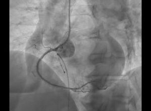 tehnica-inovatoare-pentru-afectiunile-cardiovasculare,-realizata-la-miercurea-ciuc